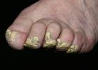 Por qué ocurre el engrosamiento de las uñas de los pies: causas y tratamiento Las uñas de los pies son gruesas y blancas